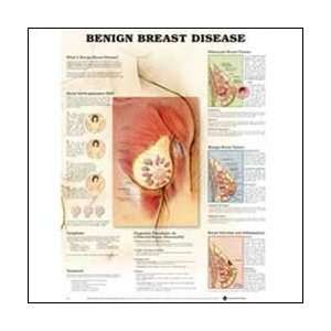  Benign Breast Disease Anatomical Chart 20 X 26 Health 